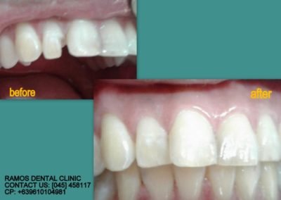 Broken Lateral Incisor Reconstruction