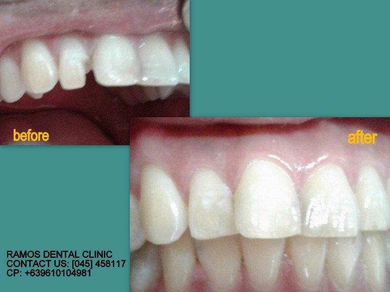 Broken Lateral Incisor Reconstruction