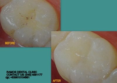 Caries Removed and Restored with Same Tooth Colored Composite Resin