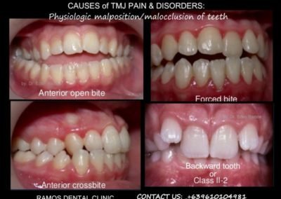 Causes of TMJ disorders