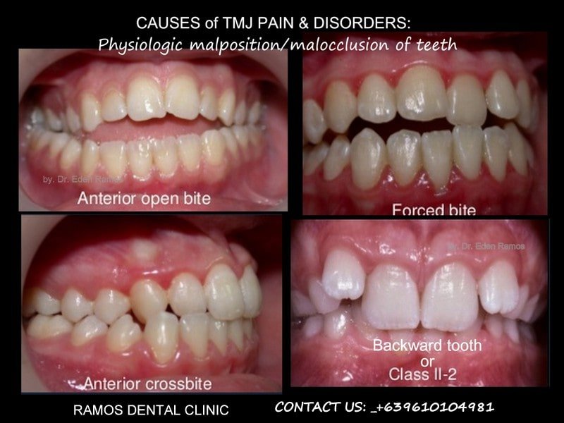 Causes of TMJ disorders