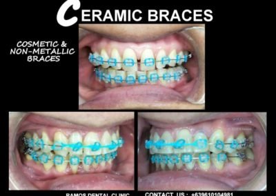 Ceramic Braces