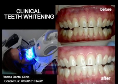 Clinical Teeth Whitening