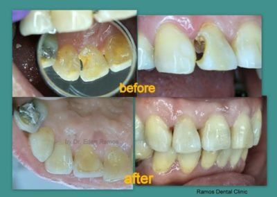 Closing A Big Carious Lesion Using Composite Resin