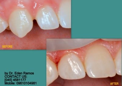 Closing Space Using Tooth Colored Composite Resin