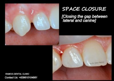 Closing the Gap Between Two Teeth