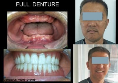 Complete Full Denture for Male Patient 48 y.o