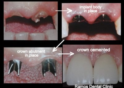 Dental Implants on Central Incisors