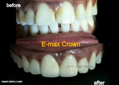 E-max Crown Front Teeth