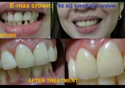 E-max Crown with Gum Contouring