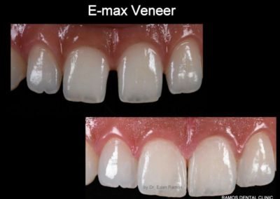 E-max Veneers for Closing Spaces in Between Teeth