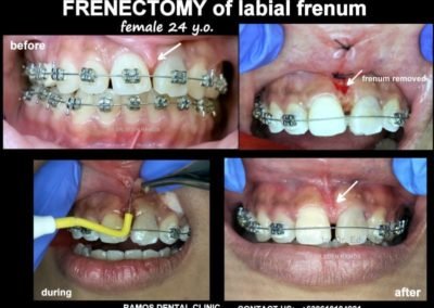 Frenectomy