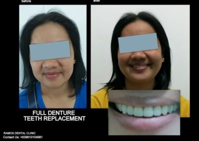 Full Denture Replacement for Worn Out and Severely Receded Bone for Female Patient 45 y.o