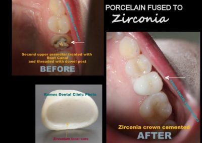 Full Zirconia Crown & Dowel Post on 1st Premolar