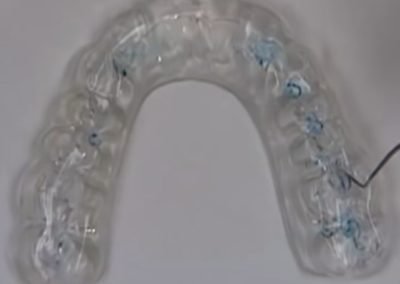 Gnathological Splint And Mouthguards 3