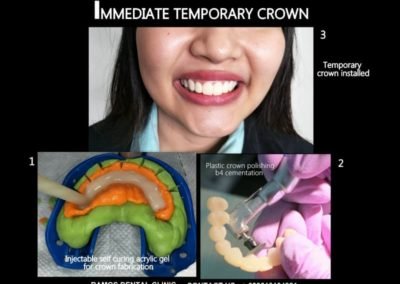 Immediate Temporary Crowns