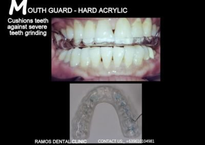 Mouthguard Hard Acrylic Resin