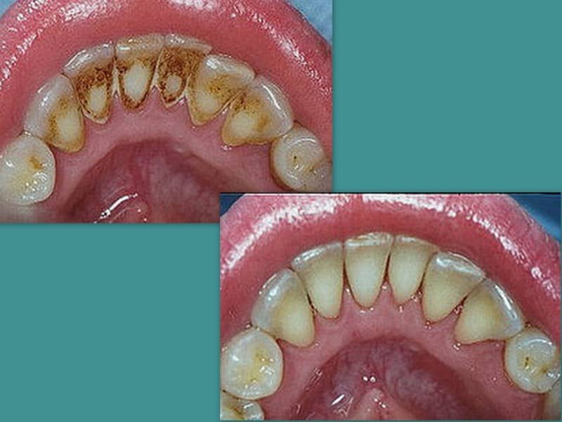 Oral Prophylaxis 