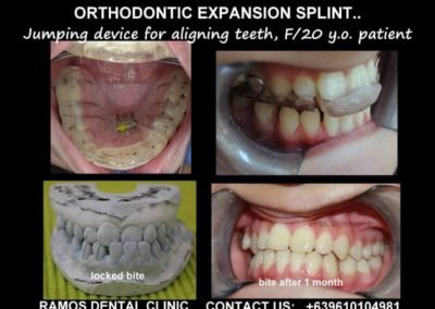 Orthodontic Expansion Splint