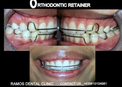 Orthodontic Retainer