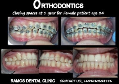 Orthodontics Female Patient