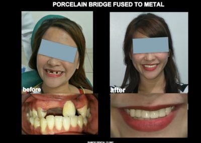 Porcelain Bridge Fused to Metal to Replace Old Denture of 25 y.o Female Patient