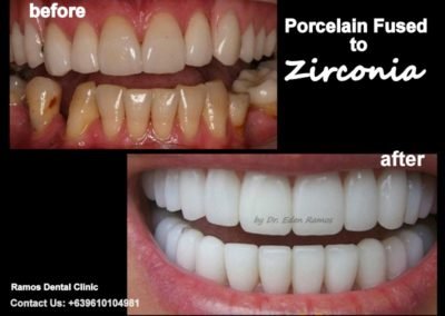 Porcelain Fused to Zirconia