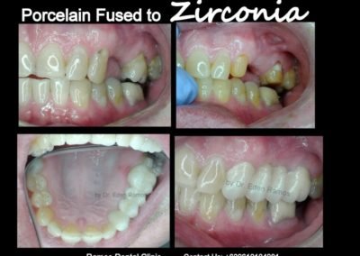 Porcelain Fused to Zirconia Upper Left Molars