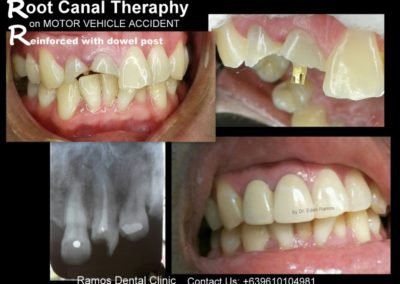 RCT And Post And Core Build Up Of A 30 Y.O Male Patient Who Had A Motor Vehicle Accident