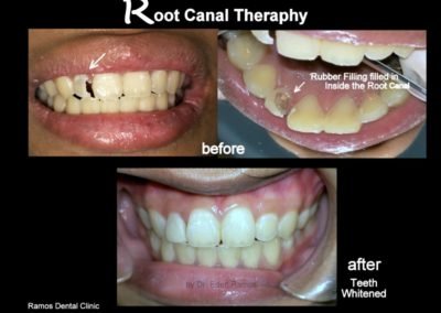 RCT and Veneer Cementations of 14 y.o Female Patient