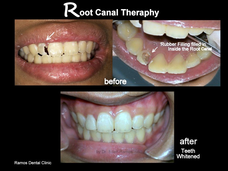 RCT and Veneer Cementations of 14 y.o Female Patient