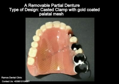 RPD with Metal Casted Clamp and Gold Mesh on Palate