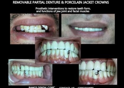 Removable Partial Denture & Porcelain Jacket Crown Combination