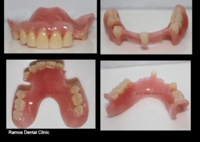 Removable Partial Denture Without Clamp