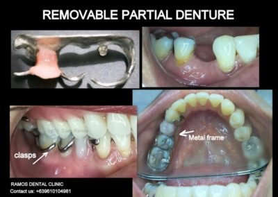 Removable Partial Denture for Missing Left Premolar for Female Patient Age 48