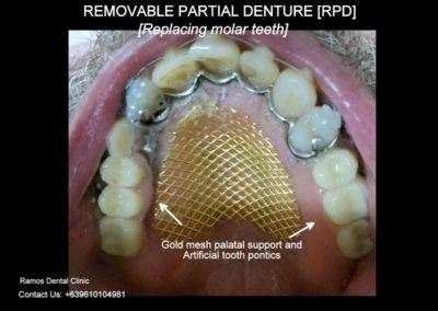 Removable Partial Denture to Replace Missing Premolar Teeth Of 63 Male Patient