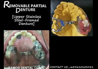 Removable Partial Denture with Stainless Steel Frame