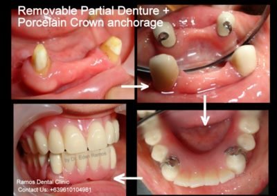 Removable Partial Denture with Jacket crown support