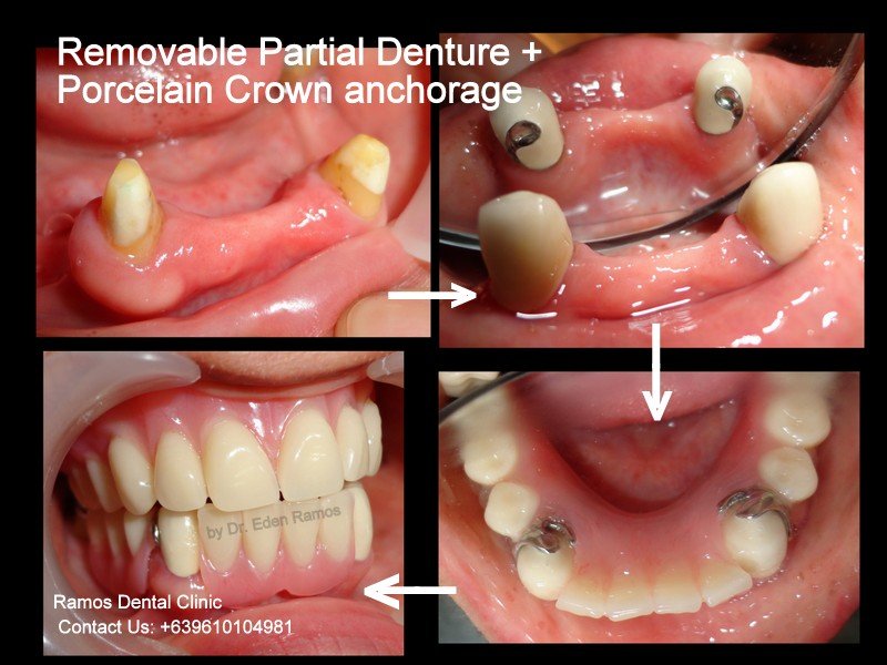 Crowns San Mateo - Sachdev Dental - Dr. Deepak Sachdev