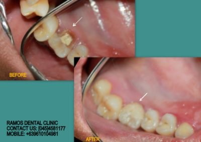 Restore Molar Build Up