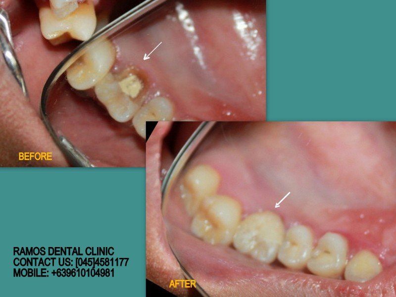 Restore Molar Build Up