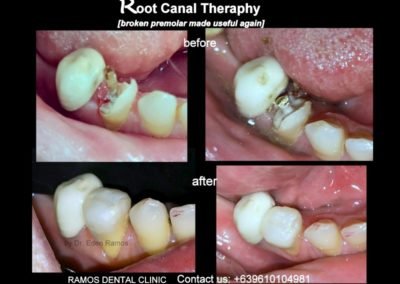 Root Canal Therapy Saving Lower Premolar Tooth of 45 y.o Female Patient