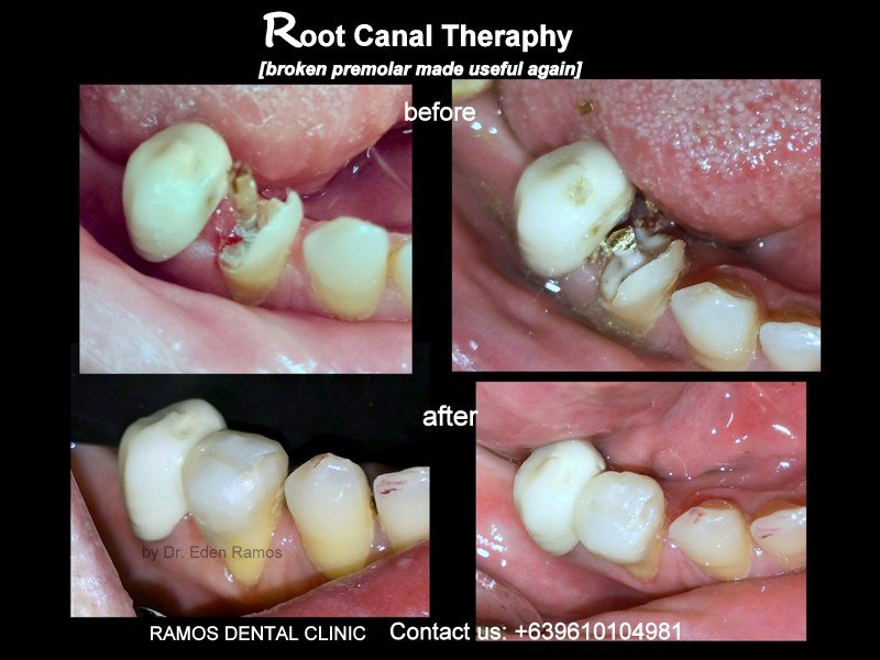 Root Canal Therapy Saving Lower Premolar Tooth of 45 y.o Female Patient