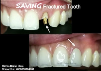 Root Canal Therapy & Zirconia Crown Replacement