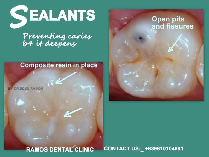 SEALANTS