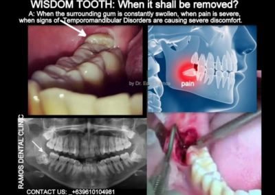 Surgery Of Wisdom Tooth