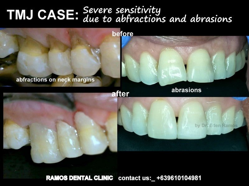 Severe Teeth Sensitivity & Abfractions