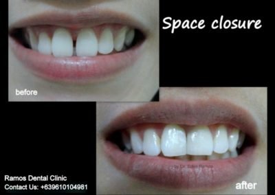 Space Closure of Front Teeth