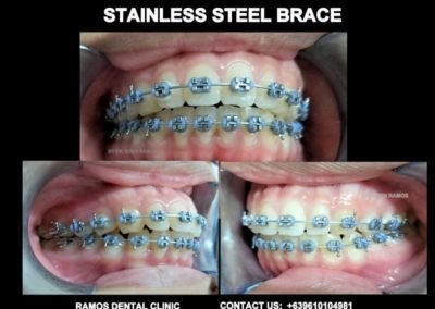 Stainless Steel Brace