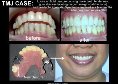 TMJ Case Due To Loose Artificial Denture